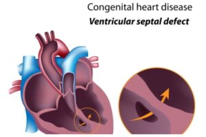 Heart Problem _ Symptoms of a hole in heart (1)