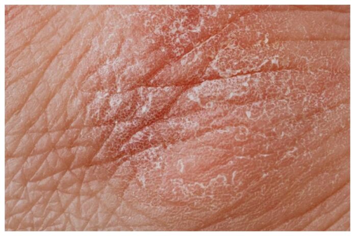 Dry skin Dry skin