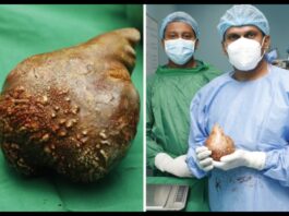 World Largest Kidney Stone