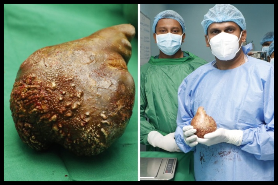 World Largest Kidney Stone World Largest Kidney Stone