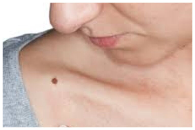 Mole on Body: शरीर पर मौजूद तिल जीवन के बारे में देते हैं कई तरह के संकेत, जाने सामुद्रिक शास्त्र के अनुसार