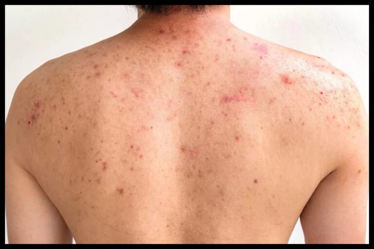 Body Acne