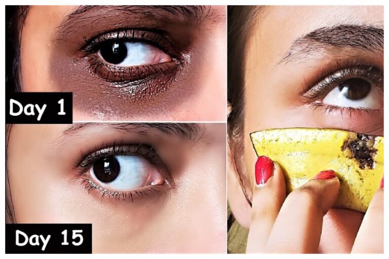 Dark Circle Remedies: इन घरेलू उपायों से आंखों के नीचे काले घेरे हो जाएंगे छूमंतर, फॉलो करें ये टिप्स