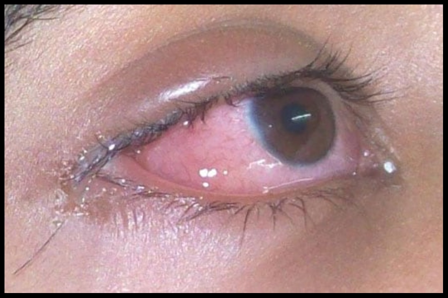 Eye Flu Eye Flu
