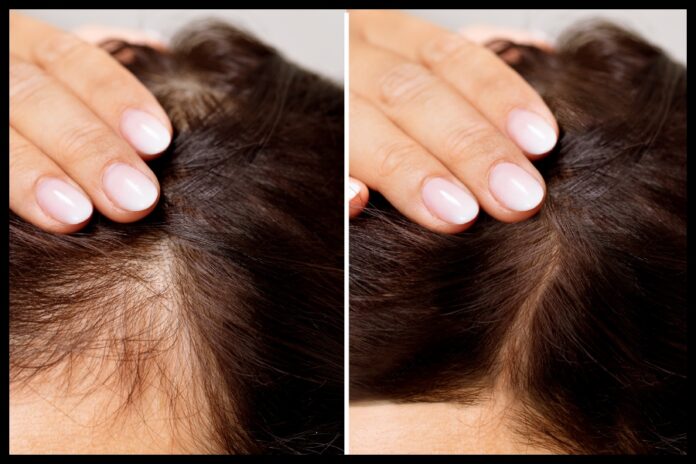 Hair Growth