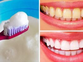 Teeth Whitening At Home