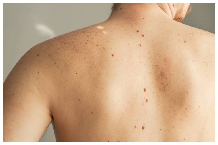 Lucky Body Moles: अगर आपके भी शरीर के इन अंगों पर हैं तिल, तो आप हैं बहुत खास