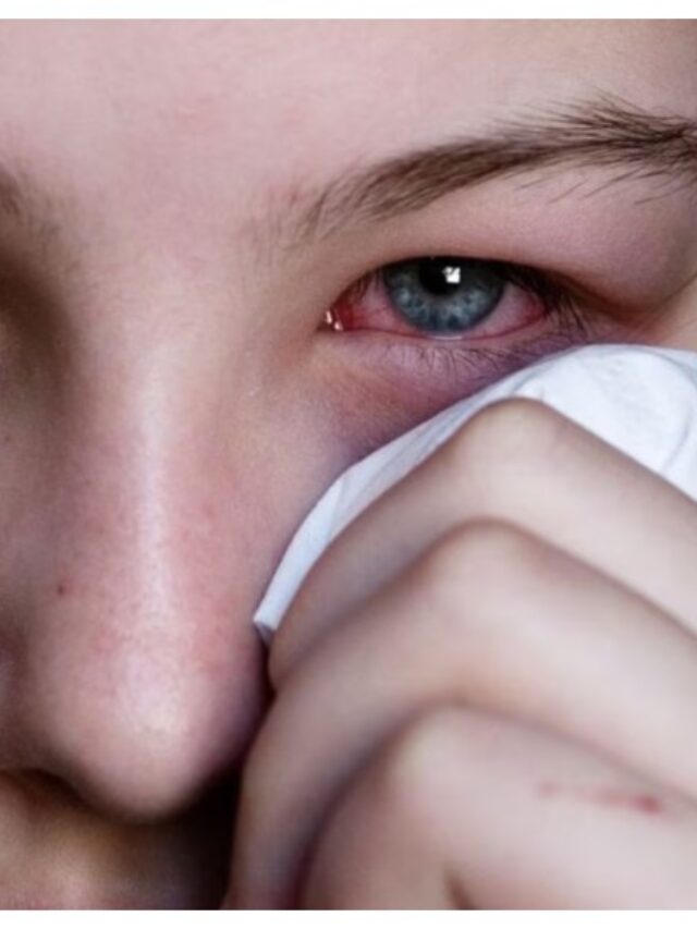 eye flu