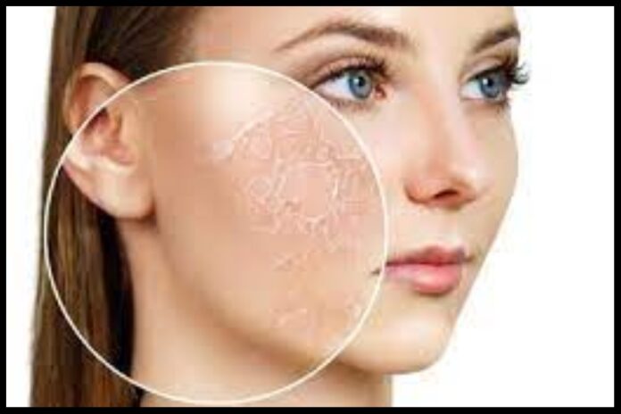 dry skin