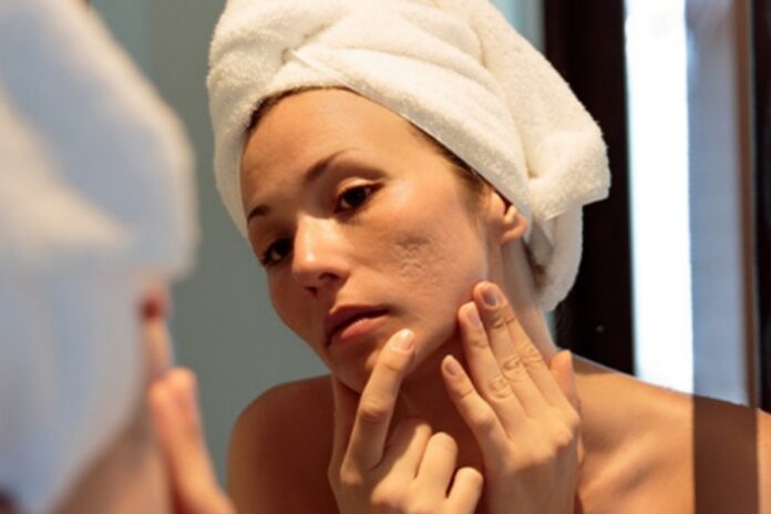 Acne Tips