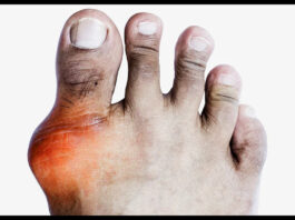 Uric Acid