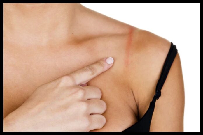 Bra Strap Syndrome Bra Strap Syndrome