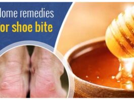 Shoe Bite Remedies