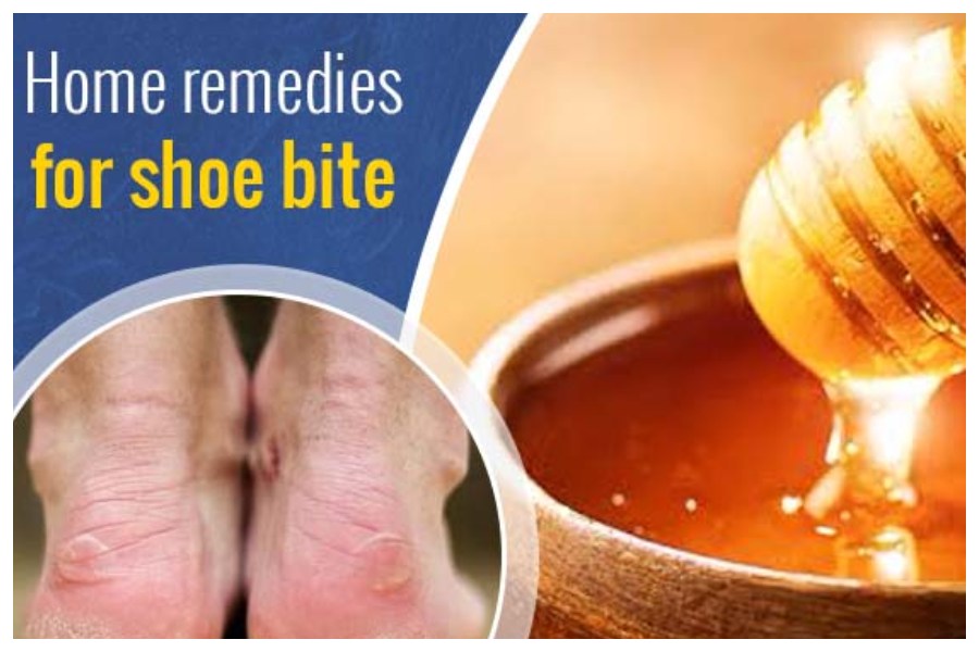 Shoe Bite Remedies