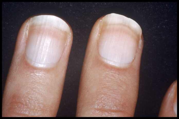 White Spots On Nails White Spots On Nails