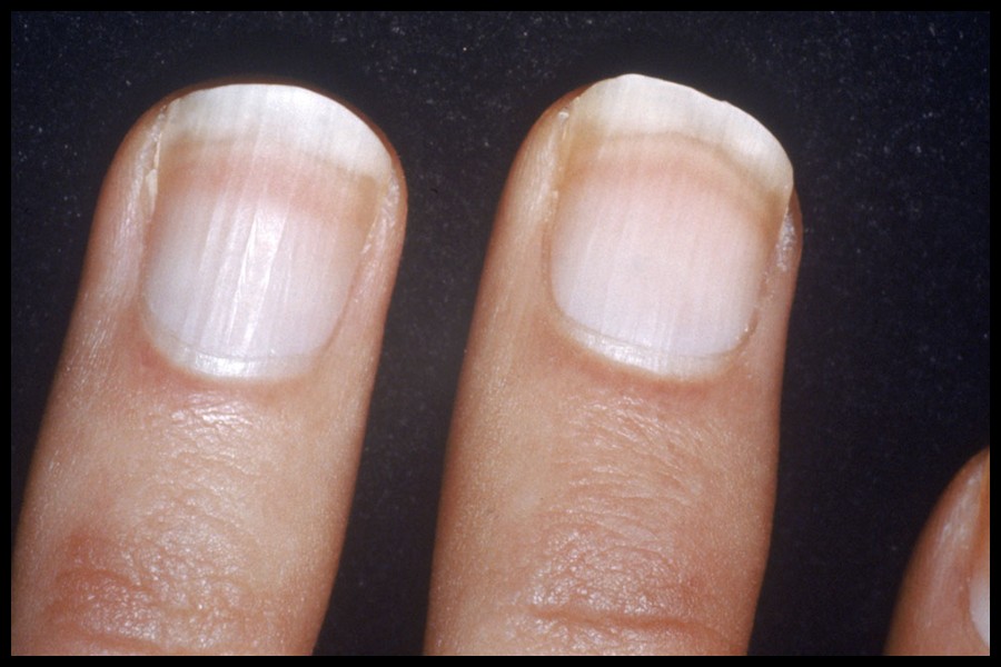 White Spots On Nails