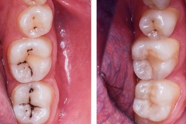 Cavity Home Remedies: दांतों में लगा कीड़ा झटपट इन सभी घरेलू उपाय से निकालें