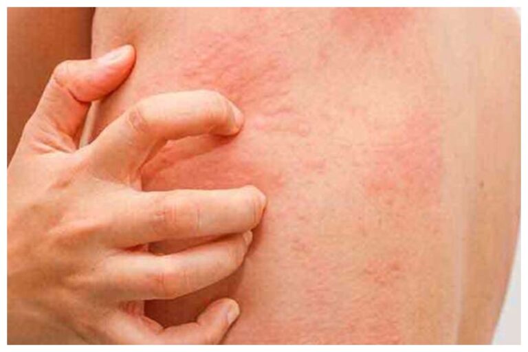 Itching Common Reason: शरीर में खुजली हो रही है तो क्या करें, हो सकती हैं ये वजह