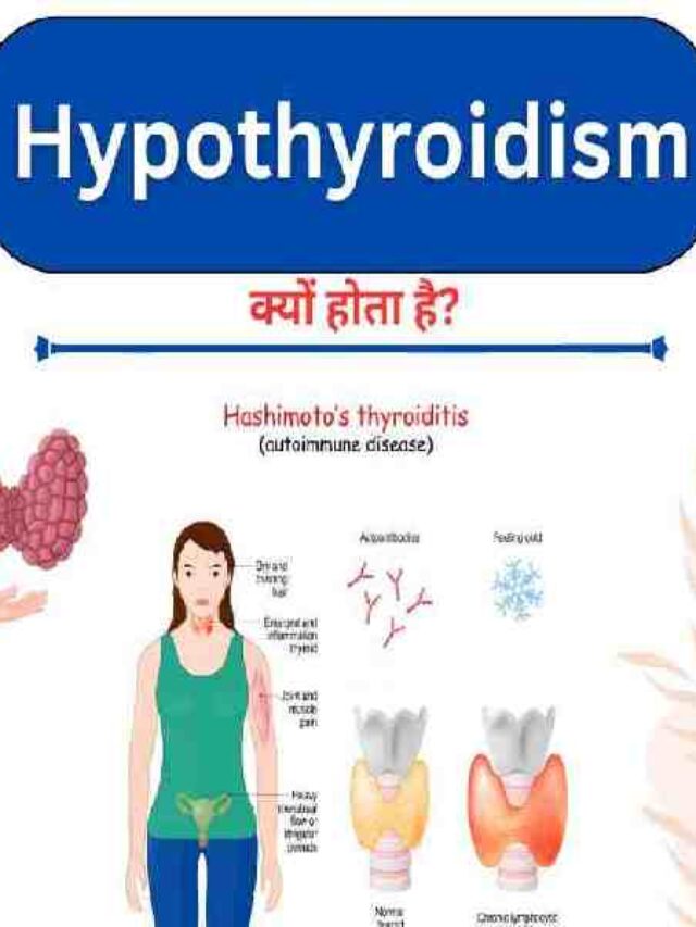 Symptoms and Treatment of Hypothyroidism