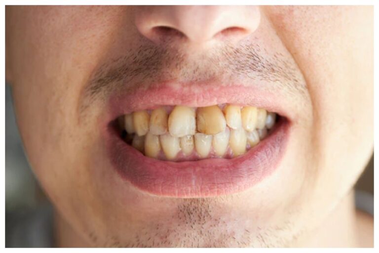 Teeth Whitening Home Remedy: दांतों का पीलापन बिगाड़ता है पर्सनैलिटी, तो इन छिलकों से मोती से चमक जाएंगे दांत