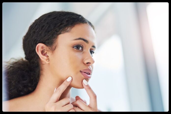 Get Rid Of Pimples