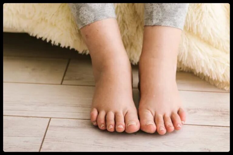 Swollen feet