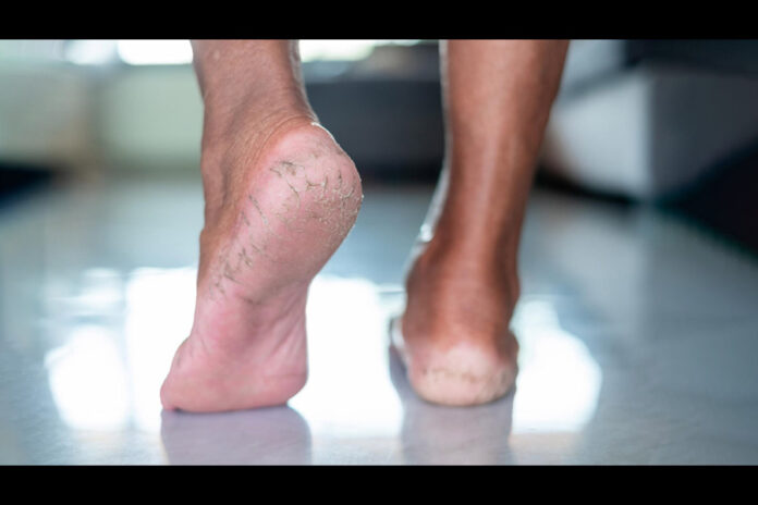 cracked-feet-treatment-at-home