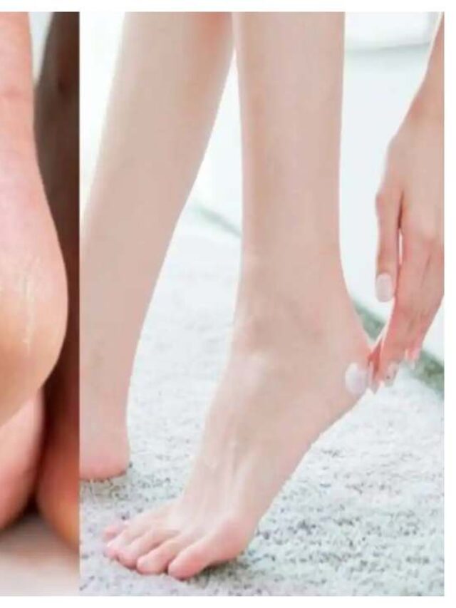 crack heel