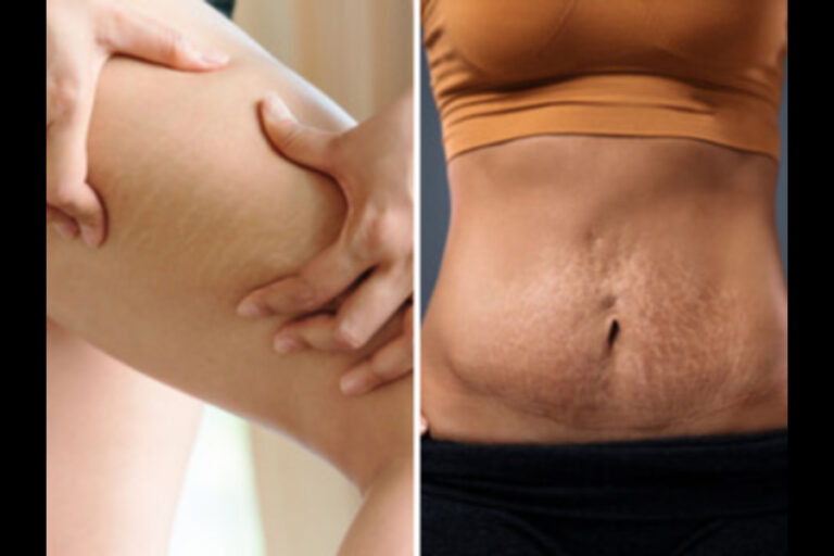 Stretch Marks Remove Tips : इन आसान तरीकों से स्ट्रेच मार्क्स से मिलेगा छुटकारा