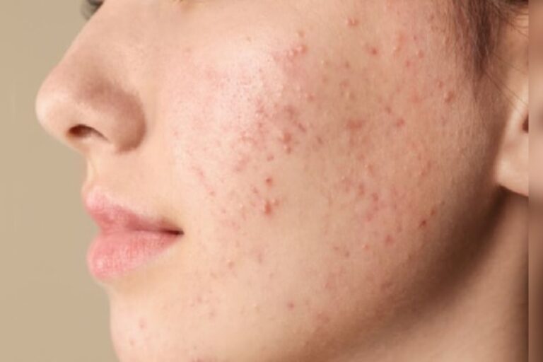 Pimples Remedy: इस फेस पैक को हफ्ते में दो बार लगा लो मुंहासे हो जाएंगे गायब