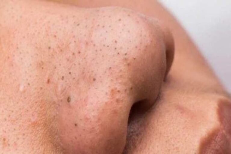 Blackheads Remove Tips: चेहरे पर ब्लैकहेड्स हटाने के 5 असरदार उपाय