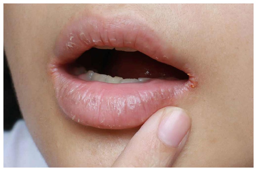 Cracked Lips
