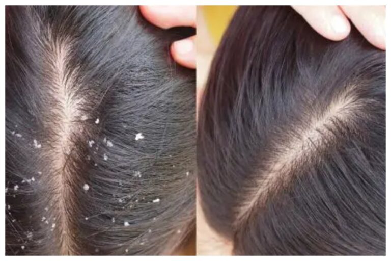 Winter Dandruff Remedies: सर्दी आते ही बालों में बढ़ने लगी है डैंड्रफ की परेशानी, इन घरेलु उपायों से मिलेगा छुटकारा