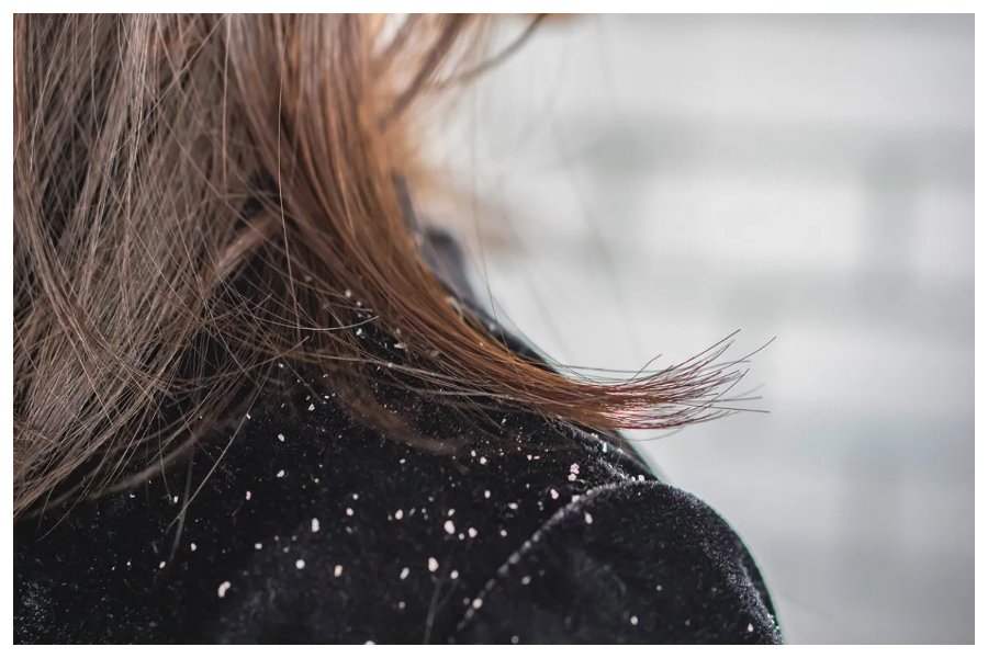 Dandruff In Winte
