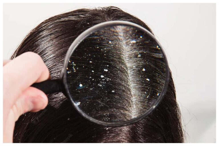 Dandruff In Winter: सर्दी आते ही बालों में होने लगी है डैंड्रफ, इन उपायों से मिलेगा समाधान