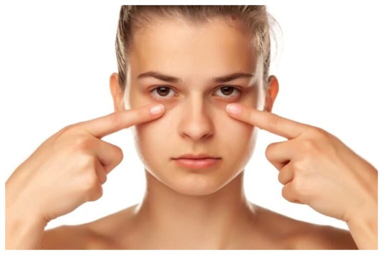Dark circles Causes & Remedy : आंखों के नीचे क्यों पड़ जाते हैं काले घेरे और क्या है इसके उपचार, आइए जानिए