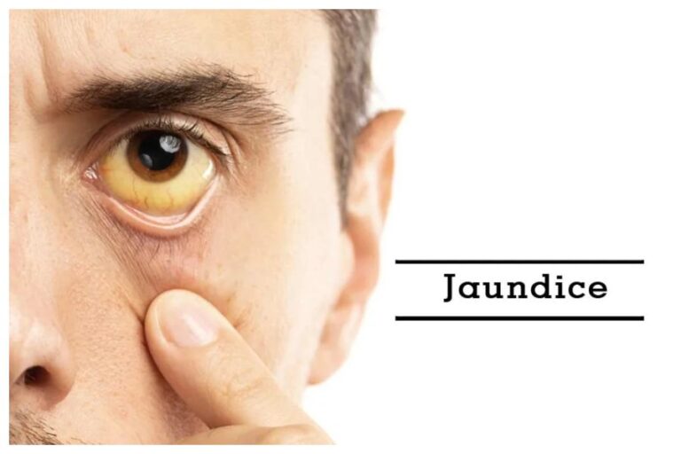 Jaundice Treatment: दवाईयों से मिलेगी राहत, पीलिया को जड़ से खत्म कर देंगे ये घरेलु उपाय, लीवर भी बनेगा मजबूत