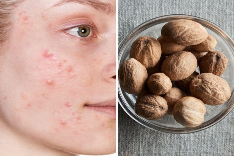 Jaiphal Benefits: पिंपल वाली स्किन के लिए वरदान है जायफल, बढ़ता है चेहरे का ग्लो