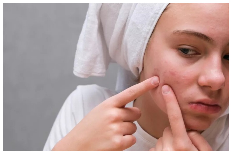 Winter Acne Causes