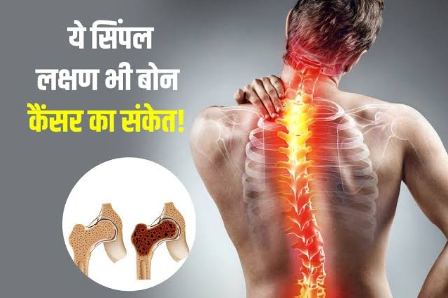 Bone Cancer Bone Cancer