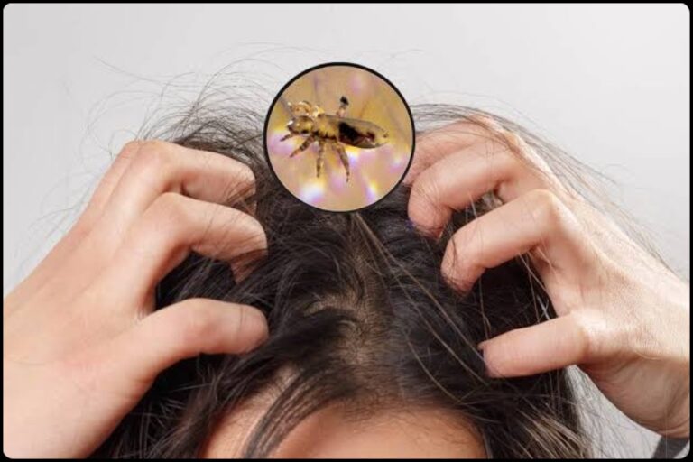Lice Treatment: