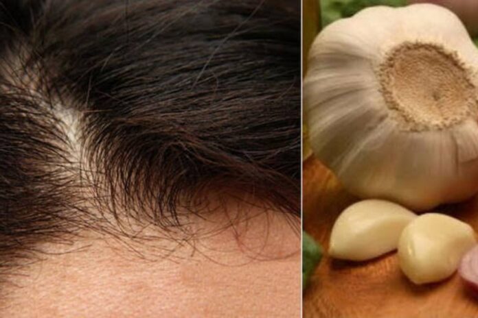 Garlic shampoo for hair fall