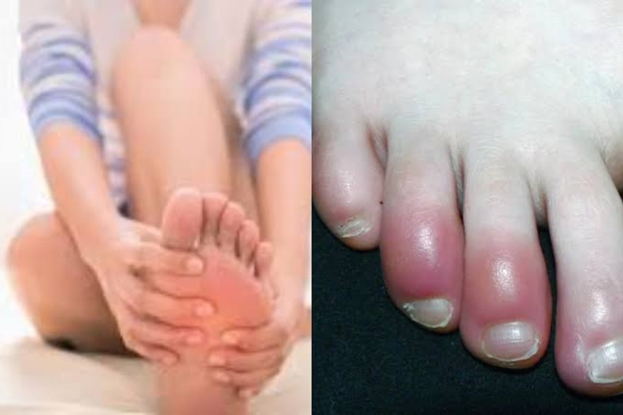 Swelling In Toes