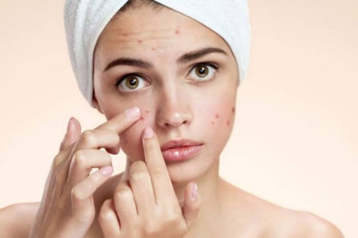 Pimples Home Remedies