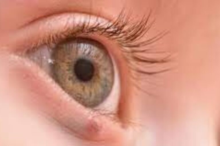 ये होते हैं आंखों के कैंसर की शुरुआती लक्षण, इन लोगों को ज्यादा रहता है Eye Cancer का खतरा