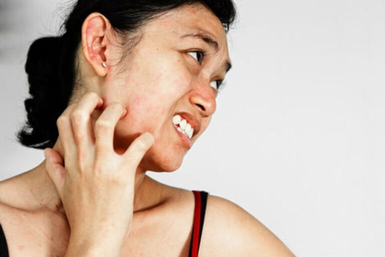 Itching Face Tips: सर्दियों में चेहरे पर हो रही खुजली, इन टिप्स को करें फॉलो