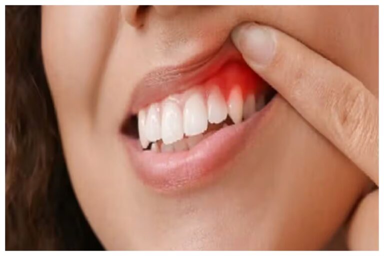 Bleeding Gums Problem: ब्रश करते समय दातों से आता है खून तो इस बीमारी का है संकेत