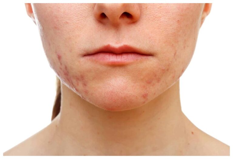 Pimples/Acne In Winter: जाती हुई सर्दी में भी कम नहीं हो रहे ये चेहरे के फुंसी-फोड़े, तो अपनाएं ये उपाय अभी