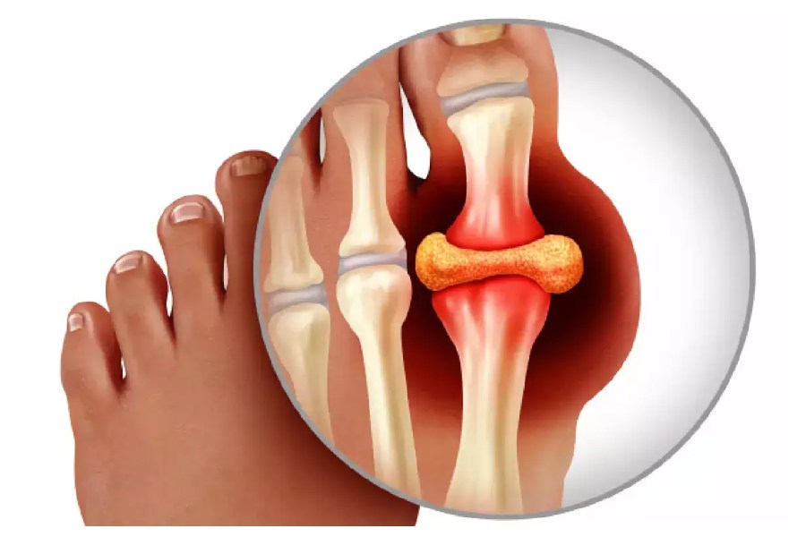 Uric Acid