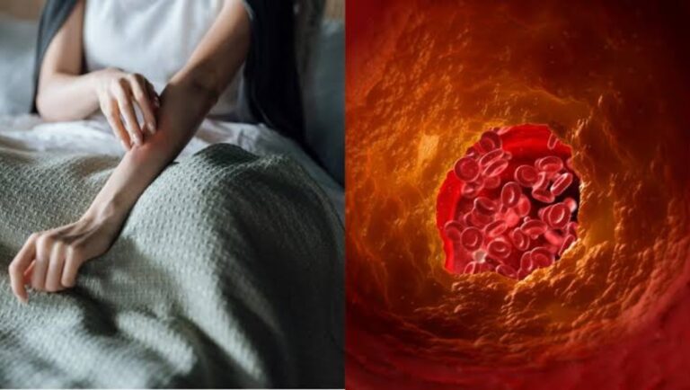 High Cholesterol Symptoms:जान ले सकता है बैड कोलेस्ट्रॉल, इस तरह करें बढे हुए कोलेस्ट्रॉल की पहचान